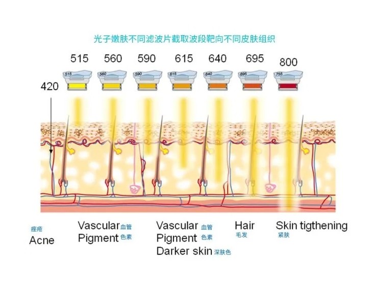 五大光子嫩膚技術(shù)（IPL、DPL、OPT、APT、BBL）及濾光片區(qū)別