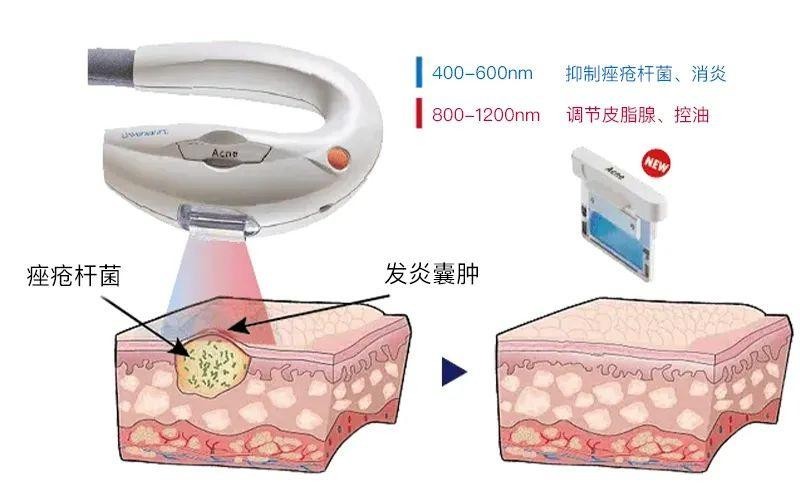 Acne痤瘡濾光片作用